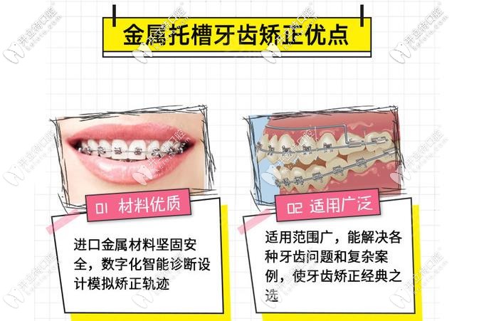 金屬矯正的優(yōu)勢