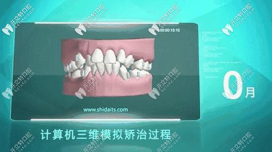 數(shù)字化隱形矯正的矯治過(guò)程 數(shù)字化隱形矯正的矯治過(guò)程