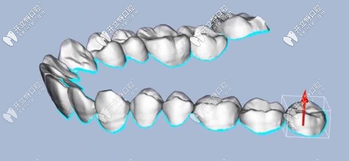 牙齒矯正的模擬圖 牙齒矯正的模擬圖