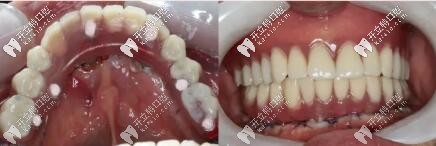 3d導板all-on-6即刻種植牙當天恢復全口,價格10多萬是有道理的 