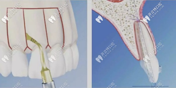 牙周植骨手術(shù)要多少錢是因人而異,但真沒網(wǎng)傳幾十萬那么貴!