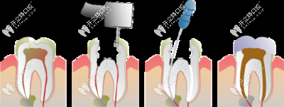 根管治療的過(guò)程 根管治療的過(guò)程