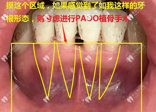 牙周植骨手術(shù)的費用要多少錢呢