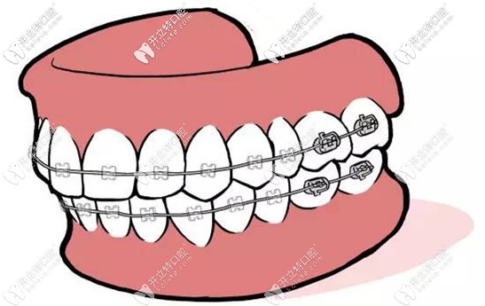 陶瓷自鎖托槽的價(jià)格及優(yōu)勢(shì)