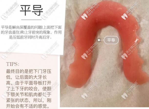 牙齒矯正平導(dǎo)的作用