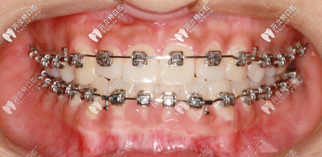 先戴頜墊再做矯正