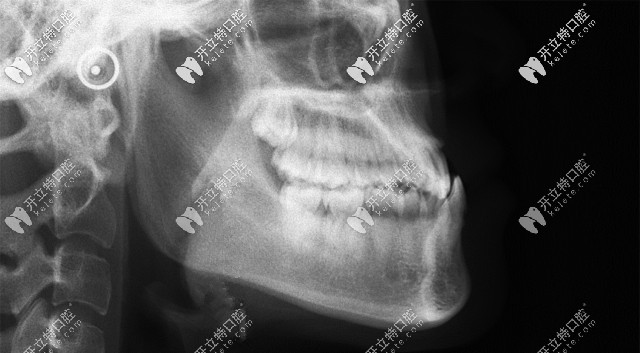 骨性地包天矯正