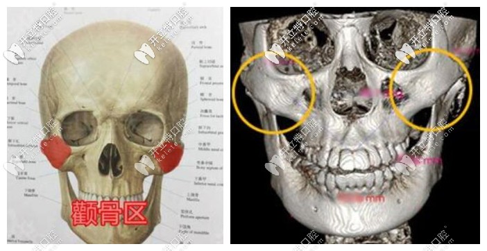 不清楚顴骨具體位置的下邊這張圖