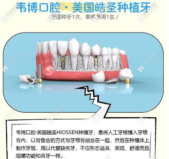 下沙韋博口腔美國皓圣種植牙價格