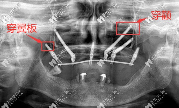 深圳正夫口腔熊靖宇穿顴穿翼板種植牙案例