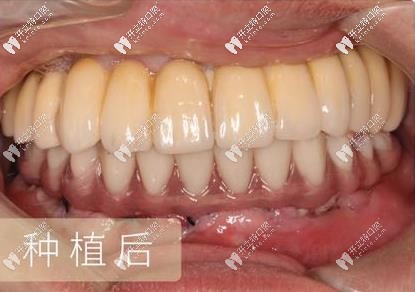 種植牙后的樣子
