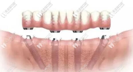 全口缺失種植牙