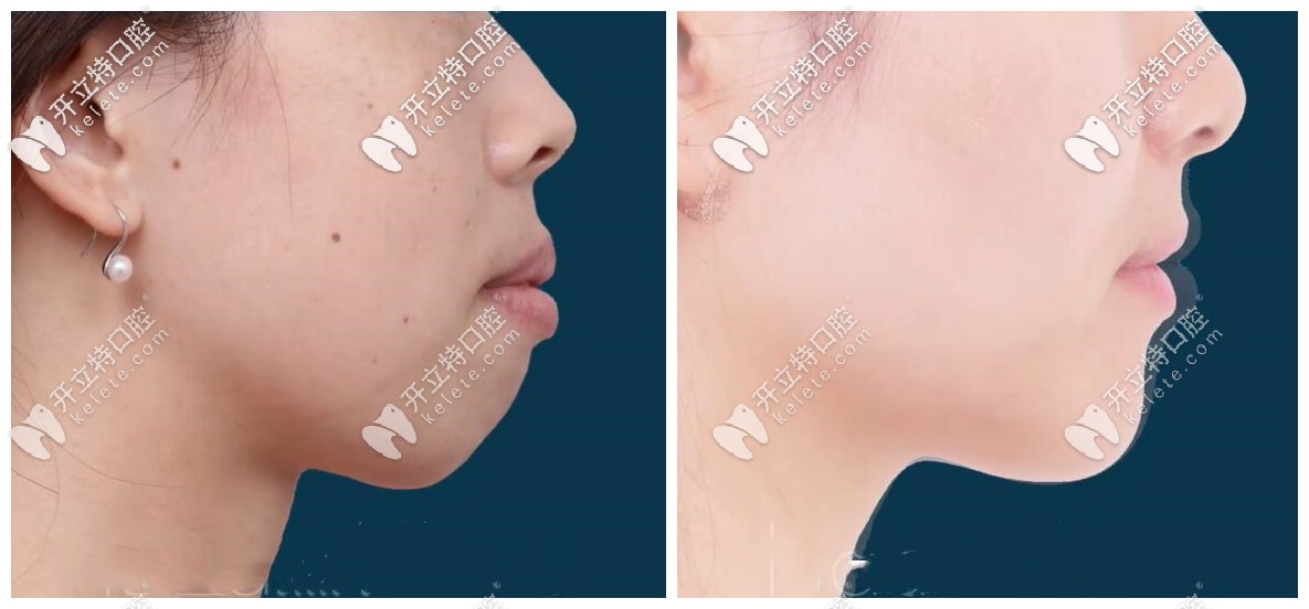 年齡28+的突嘴齙牙小姐姐表示，矯正不亞于整容