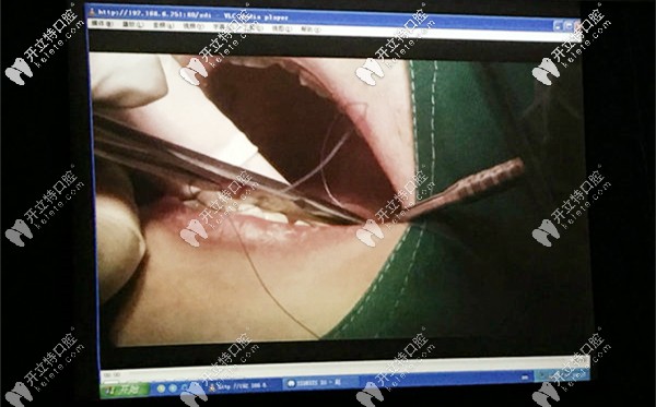 種植牙手術(shù)直播現(xiàn)場