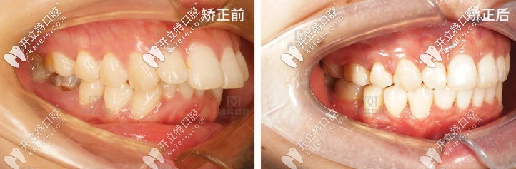 成年后牙齒越來(lái)越突