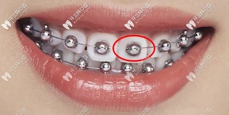 obrace球面自鎖托槽的圖片