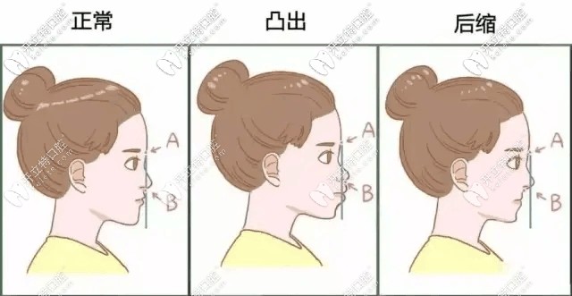 牙齒矯正前后臉型變化圖