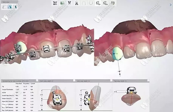 廣州柏德3D口掃的效果圖