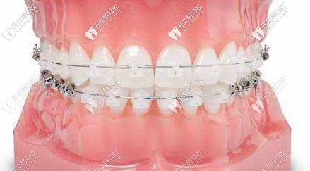 陶瓷半隱形矯正