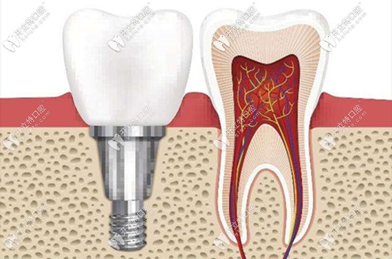 種植牙的費(fèi)用主要包含種植體、牙冠這兩大塊