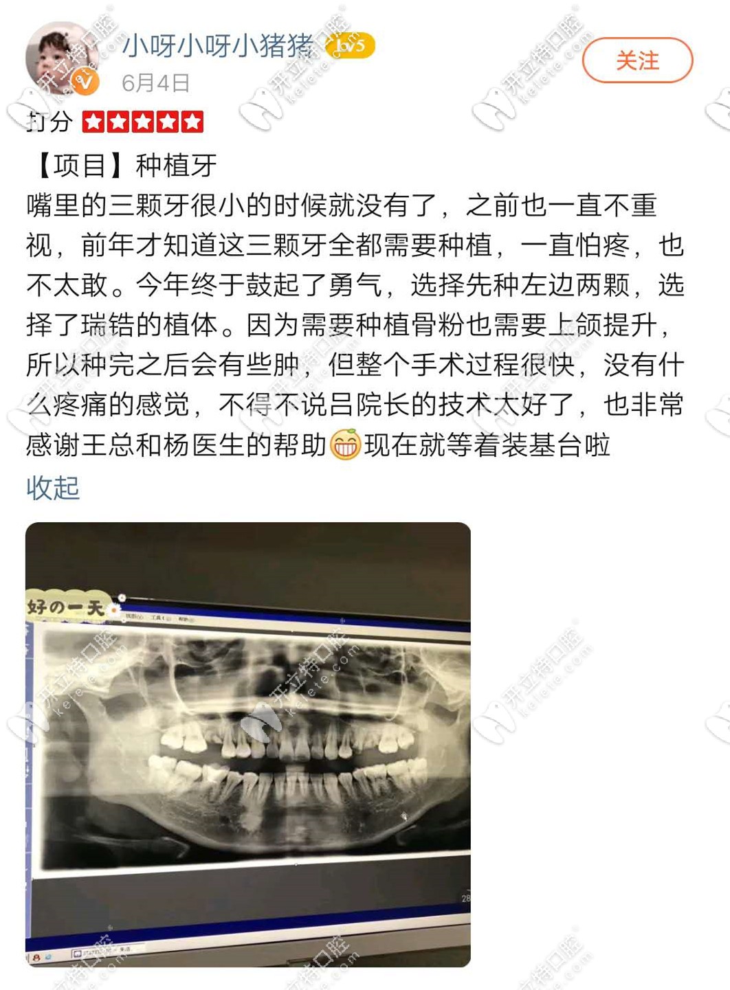 <!--<i data=20240703-sp></i>-->種植牙真心不錯