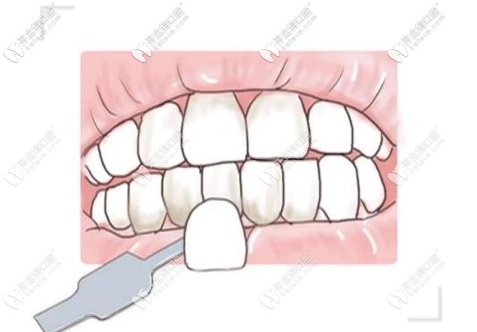 牙齒貼面修復(fù) 牙齒貼面修復(fù)