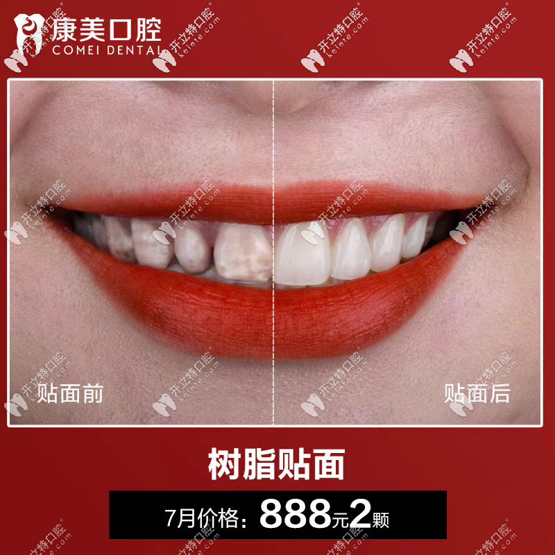 樹(shù)脂貼面888元2顆 樹(shù)脂貼面888元2顆