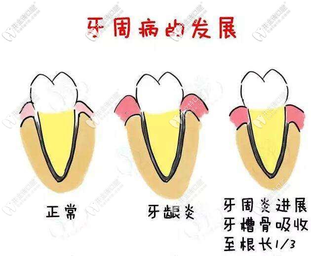 正畸前需要先進行牙周治療