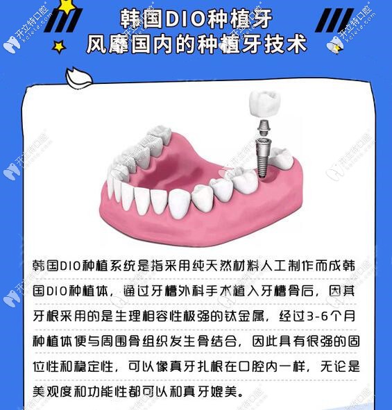 韓國DIO種植牙怎么樣