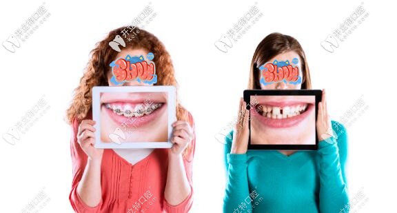 進口金屬自鎖牙齒矯正