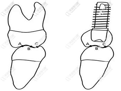 活性親骨種植擁有更強的支撐力
