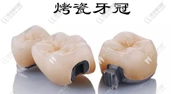 烤瓷牙邊緣發(fā)黑怎么修復(fù)