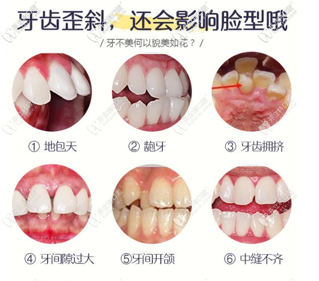 為什么要矯正牙齒