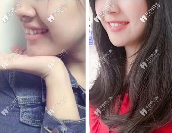 銘德口腔矯正牙齒前后對(duì)比圖