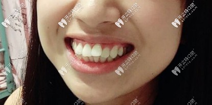 骨性+牙性齙牙，咬合有問(wèn)題