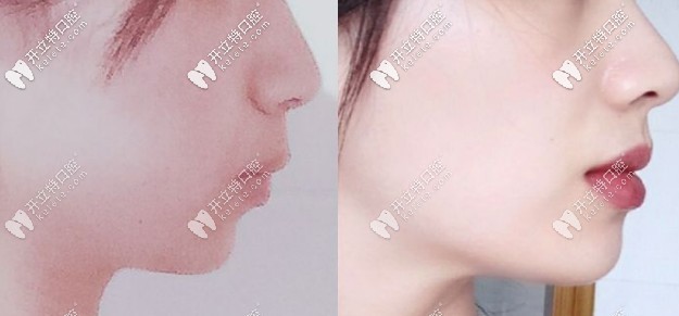 凸嘴戴鋼牙套的側(cè)臉變化圖