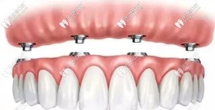 all-on-4半全口種植牙