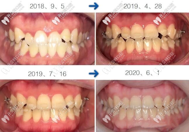 隱形牙齒矯正過程對比