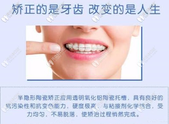 半隱形矯正的優(yōu)勢