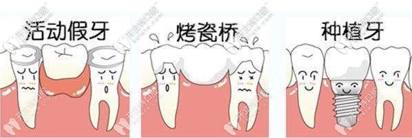 鑲牙分為活動假牙、烤瓷牙及種植牙