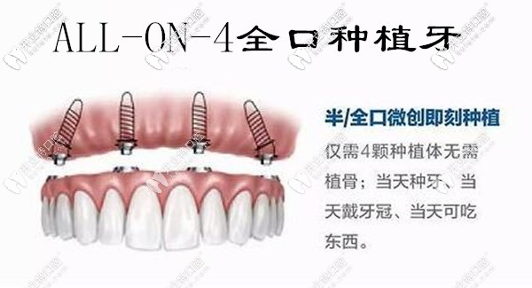 allon4全口種植牙
