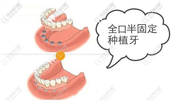 全口半固定種植牙