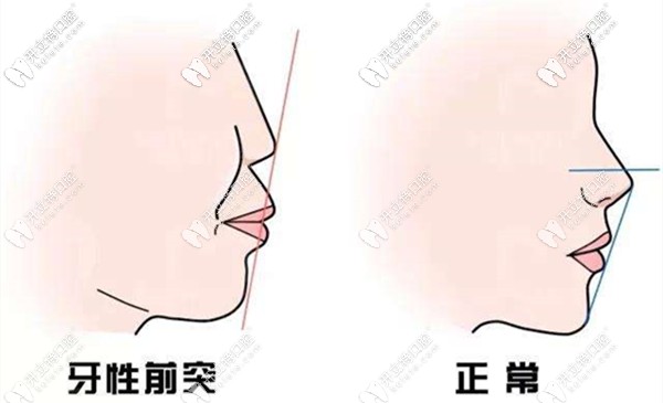 看到許多人在整牙后改變了側貌 看到許多人在整牙后改變了側貌