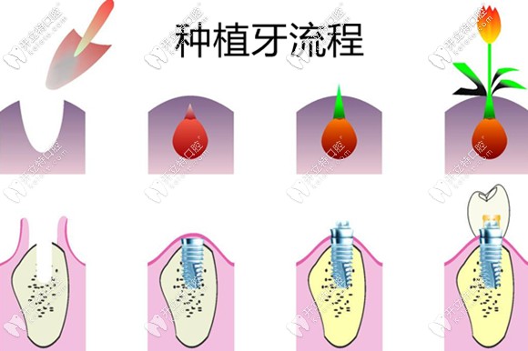 種植牙的過程及流程
