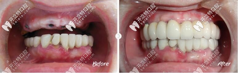 全口種植牙病例