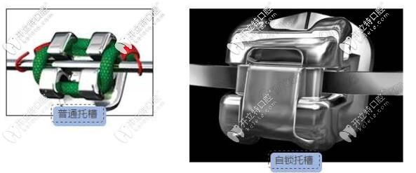 自鎖托槽和非自鎖區(qū)別