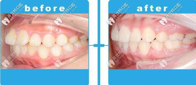 沈陽百嘉麗口腔牙齒矯正案例