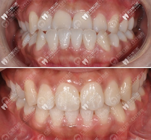 <!--<i data=20240703-sp></i>-->口腔反頜矯正案例對(duì)比△