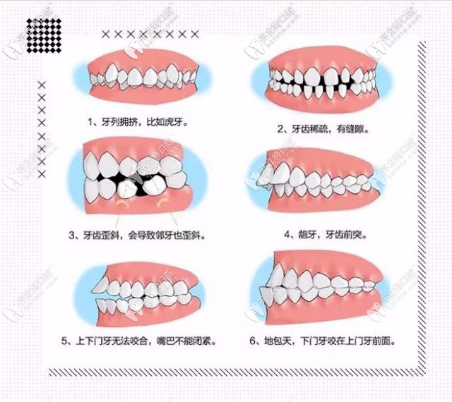 牙齒不齊的類型及危害