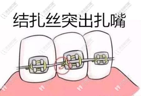 傳統(tǒng)非自鎖金屬托槽扎嘴